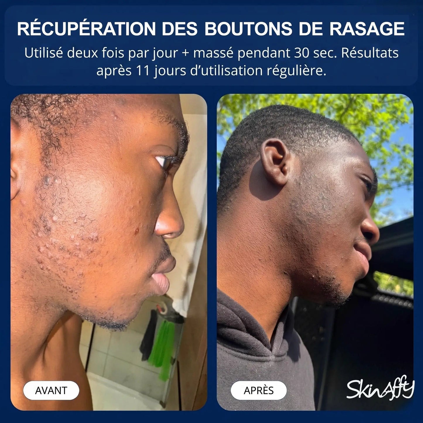 Skinaffy™ Traitement Anti-Poils Incarnés