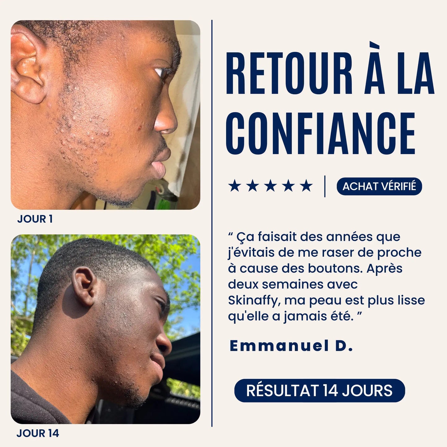 Skinaffy™ Traitement Anti-Poils Incarnés