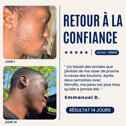 Skinaffy™ Traitement Anti-Poils Incarnés