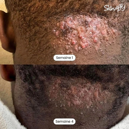 Skinaffy™ Traitement Anti-Poils Incarnés