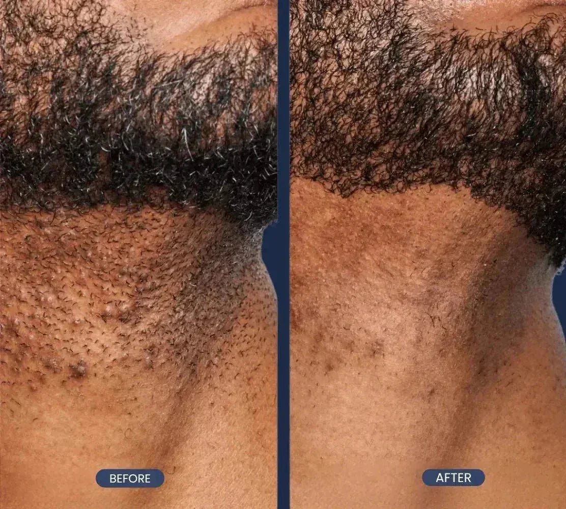 SkinAffy™ Vibrating Face Brush - Skinaffy | Ingrown Hair Treatment